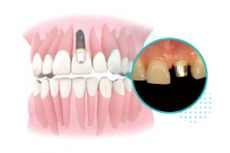 앞니임플란트